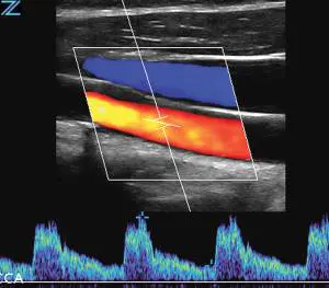 ZONE Sonography® tehnologija